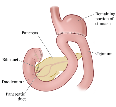 gastrectomy